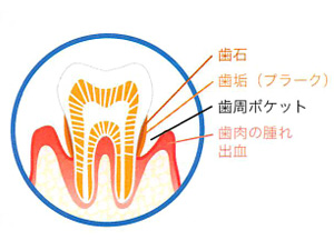 進行する歯周病