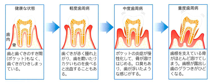 歯周病の症状