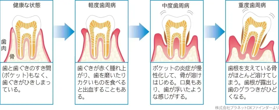 歯周病治療の進行度と方法