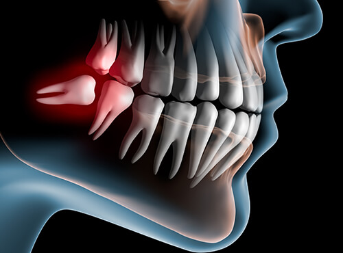 実はリスクがある親知らずの抜歯